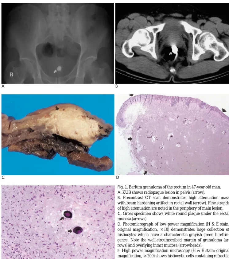 Fig. 1. Barium granuloma of the rectum in 47-year-old man.