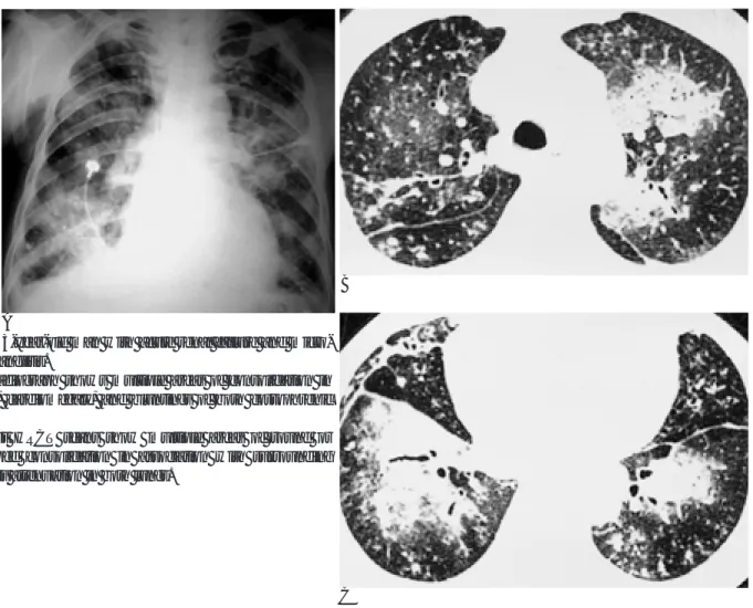 Fig. 12. A 63-year-old man with acute renal failure and micro- micro-scopic polyangiitis.