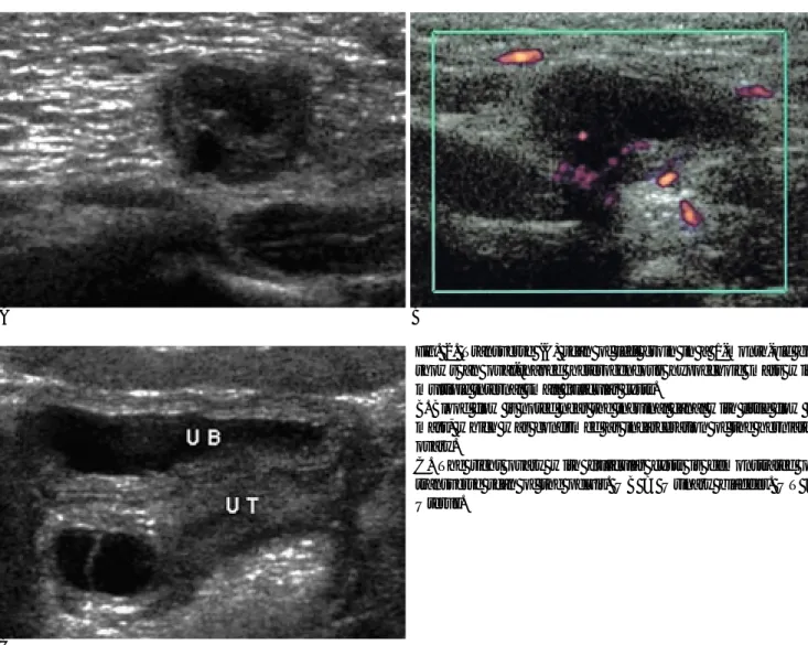 Fig. 2. Transverse (A) scan of left groin in a 1-month-old girl shows an oval-shaped heterogeneous hypoechoic mass with multiple internal small follicular cysts.