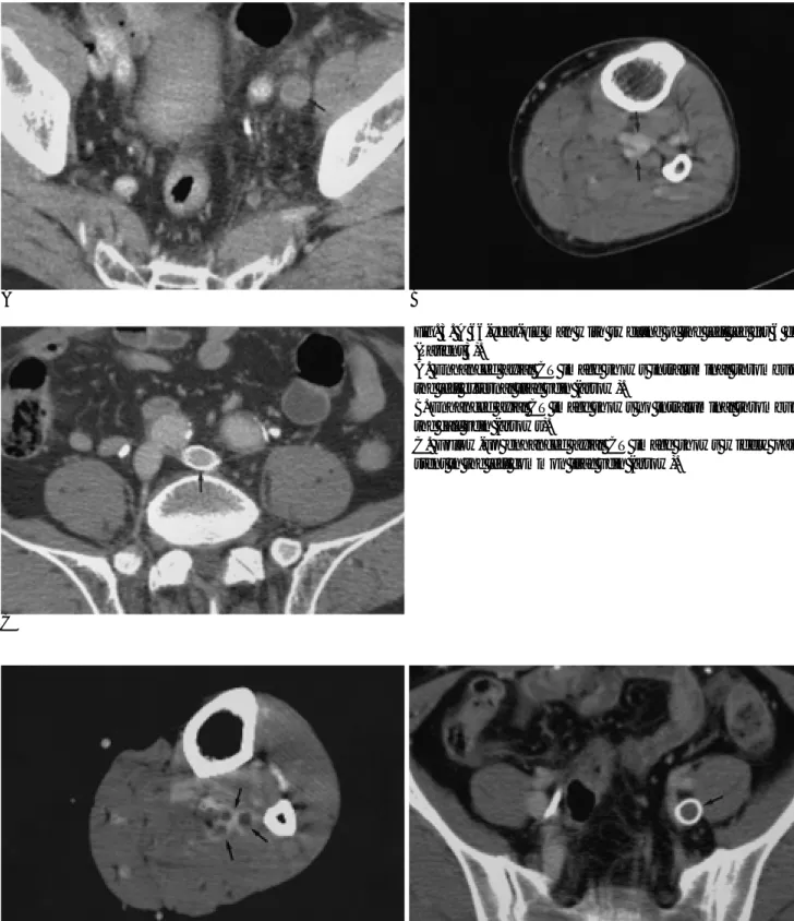 Fig. 3. A 66-year-old man with swelling of the left leg for 6 days (Patient 3).