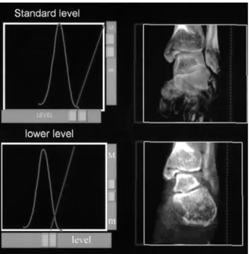 Fig. 2. Postprocessing using gray scale manipulation. The initial intersection plane shows the standard level of gray scale by auto gray scaling