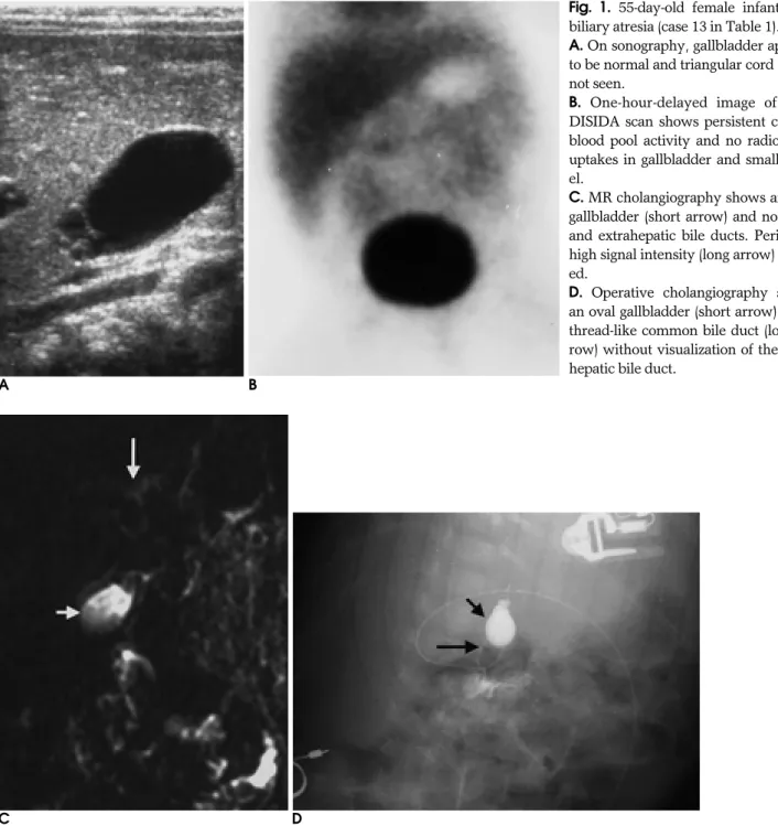 Fig. 1. 55-day-old female infant with biliary atresia (case 13 in Table 1).