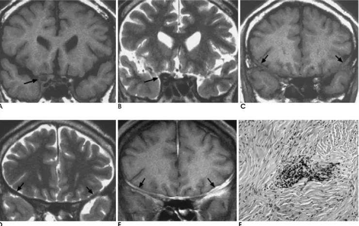 Fig. 1. A, B. Coronal T1-weighted image (A) shows iso-signal intensity mass (arrow) in right cavernous sinus, and the mass is hy- hy-pointense (arrow) on coronal T2-weighted image (B).