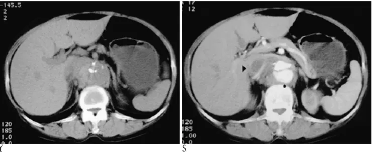 Fig. 1. A. Pre-enhanced CT scan shows calcification of aortic wall and low attenuation mass on contact with aorta.