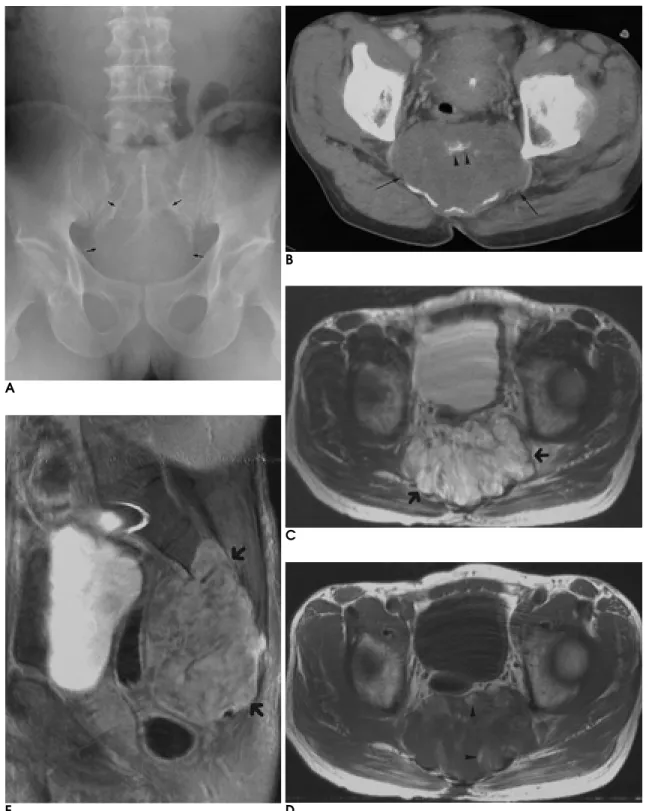 Fig. 5. A 61-year-old man with sacral chordoma.