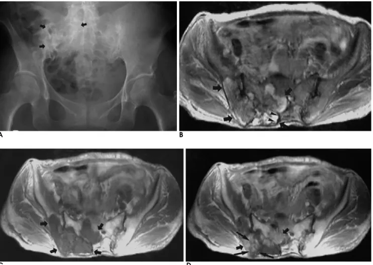 Fig. 6. A 59-year-old woman with chondrosarcoma.