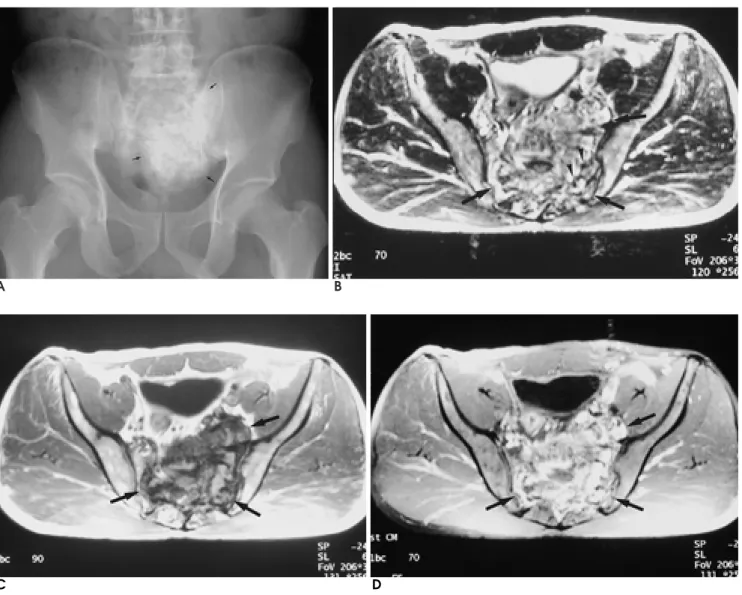 Fig. 9. A 46-year-old man with sacral osteosarcoma.