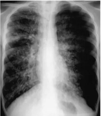 Fig. 1. HRCT in a 9-year-old boy. CT scans show (A) bilateral, diffuse bronchial wall thickening and bronchiectasis in both upper lobes and (B) centrilobular nodular opacities representing dilated fluid-filled bronchioles.