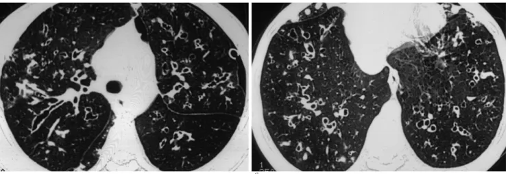 Fig. 3. Follow up HRCT on 16-year-old.