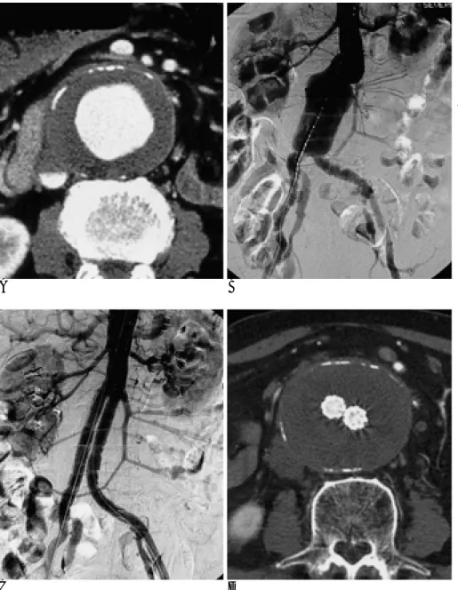 Fig. 3. 86-year old male patient with ab- ab-dominal aortic aneurysm.  Preinterven-tional computed tomography (A) and aortography (B) demonstrate an  frarenal abdominal aortic aneurysm  in-volving the aortic bifurcation.