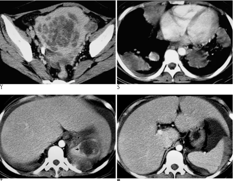 Fig. 1. A. Initial CT scan of the pelvis demonstrates a large and heterogenous mass within the pelvic cavity