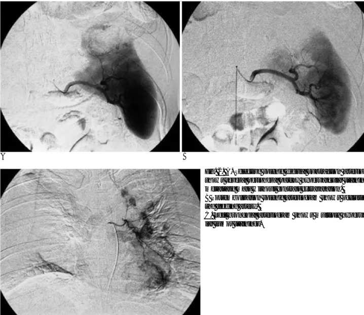 Fig. 2. A. Selective splenic digitial subtraction arteriogram shows several peripheral patchy hypervascular stainings of metastatic mass without contrast extravasation