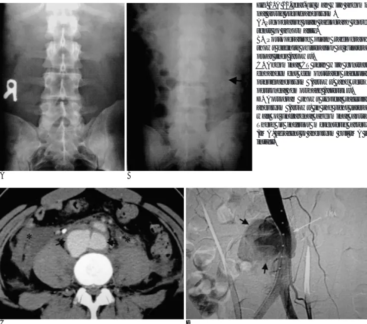 Fig. 1. A 22-year-old man with abdomi- abdomi-nal aortic pseudoaneurysm.