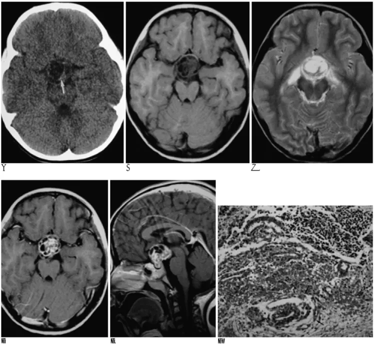 Fig. 1. A 5 year-old-girl with suprasellar mixed germ cell tumor.