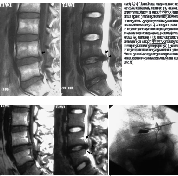 Fig. 1. A 22-year-old male patient with an extruded disc. Sagittal T1-weighted turbo spin-echo image (600/12) (left) shows low signal intensity change (black arrow) at the anterior epidural space around the L4-5 disc, compared with high signal intensity at