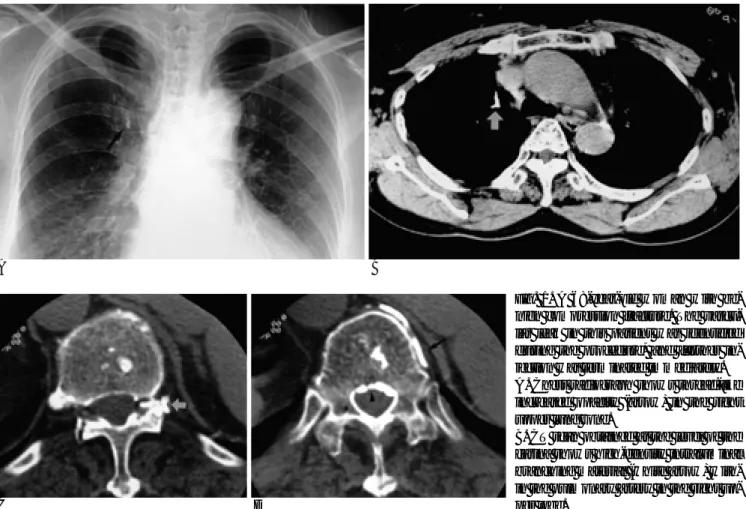 Fig. 1. A 68-year-old woman with be- be-nign compression fracture. The  vascu-lar leak in this patient was identified during the procedure, and further  in-jection was terminated immediately.