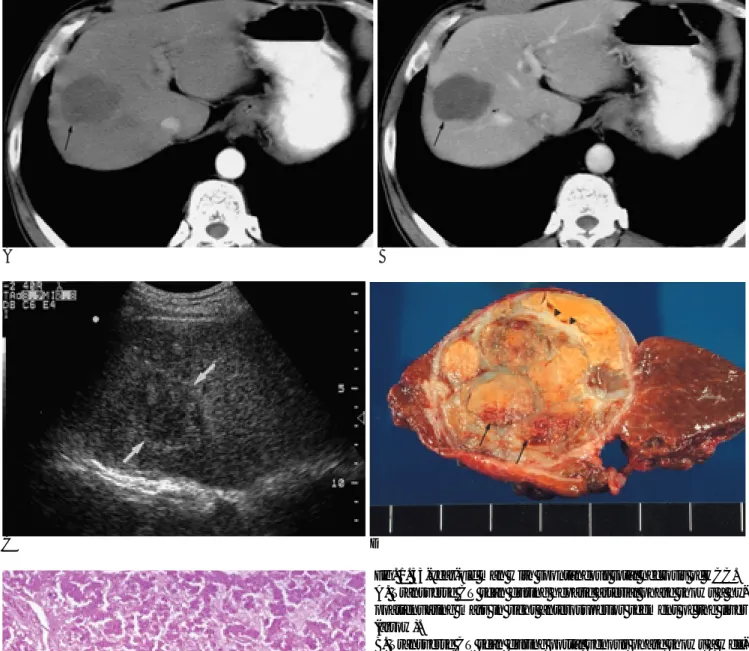 Fig. 1. 53-year-old man with spontaneous total necrosis of HCC.