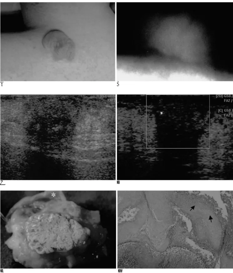 Fig. 1. A 22-year-old man with pilomatricoma.