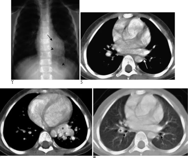 Fig. 1. A 5-year-old girl with systemic arterial supply to normal basal segments of the left lung.