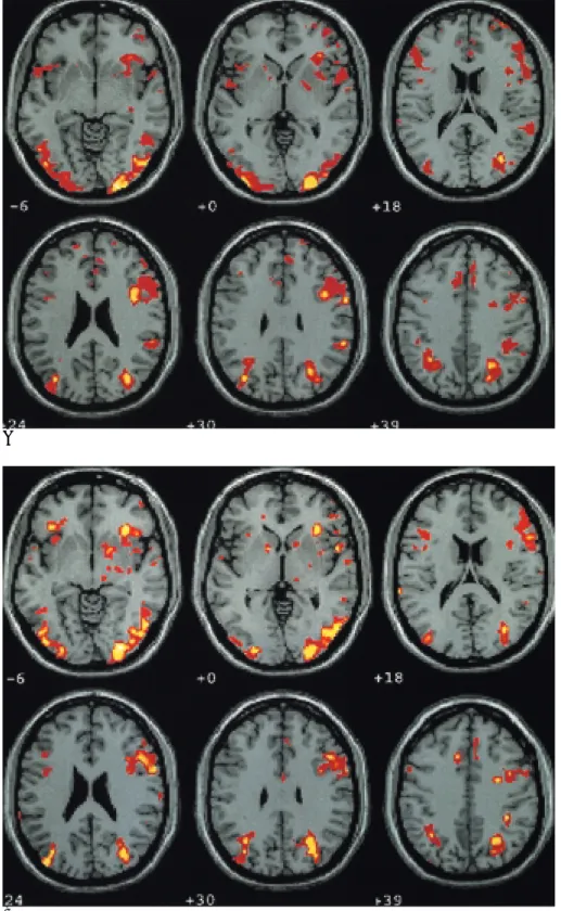 Fig. 1. BOLD-MR images from 6 con- con-tiguous axial slices: (A) implicit vs. (B) explicit retrieval of previously learned words under the level with conceptual processing