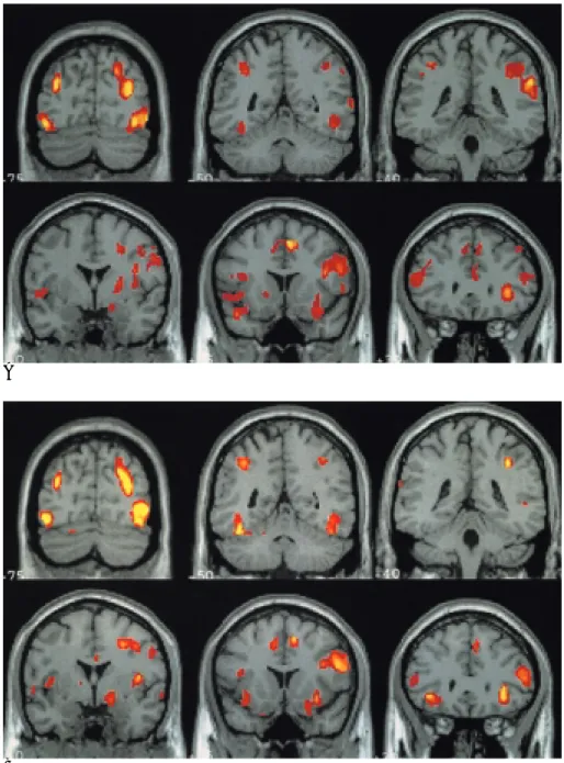 Fig. 2. BOLD-MR images from 6 con- con-tiguous coronal slices: (A) implicit vs.
