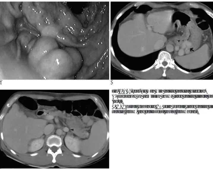 Fig. 1. A 49-year-old man with gastric variceal bleeding.
