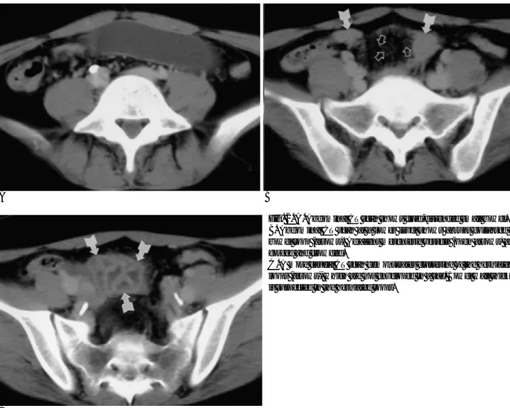 Fig. 2. A. Abdominal CT scan shows fluid-distended small bowel.