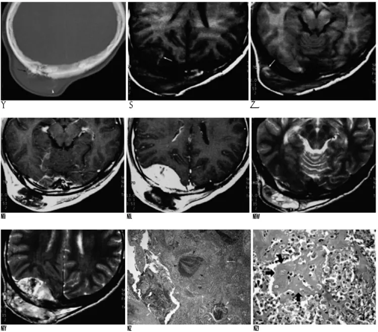 Fig. 1. Telangiectatic osteosarcoma of the skull in a 17-year-old man.