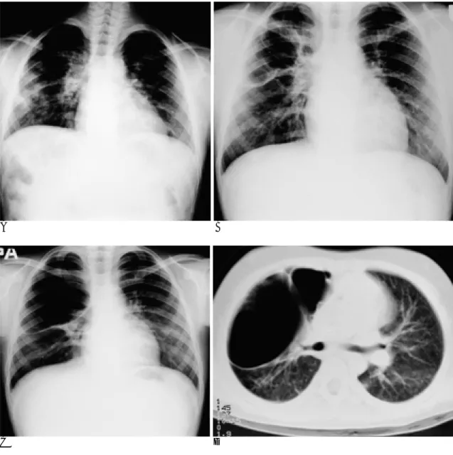 Fig. 1. Hyperimmuoglobulim E syndrome in 9-year-old child.