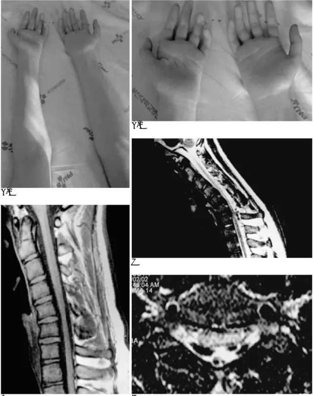 Fig. 2. A 19-year-old man presentd with progressive weakness and atrophy in left forearm and hand since 16-years-old.
