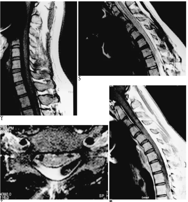 Fig. 3. A 23-year-old man with slowly progressive weakness and atrophy of the left forearm and hand.