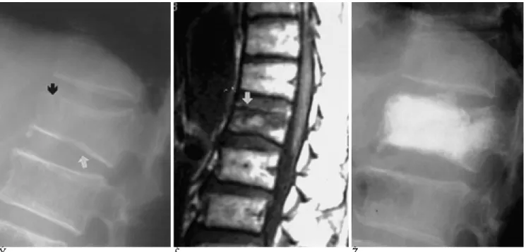 Fig. 2. A 79-year-old man with back pain from T9 compression fracture (white arrow).