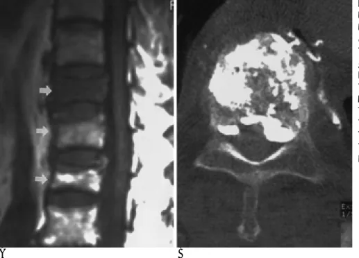 Fig. 5. A 69-year-old woman with mul- mul-tiple osteoporotic vertebral  compres-sion fractures.