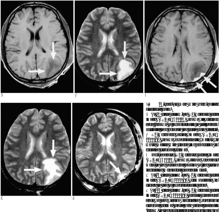 Fig. 1. 23-year-old man with high-voltage electrical burn.