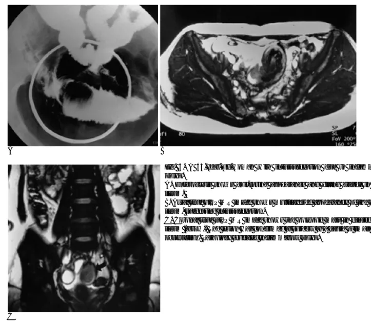 Fig. 3. A 43-year-old-woman with intussusception due to inflammatory polyp.