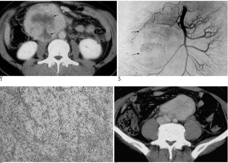 Fig. 1. A. Dynamic contrast-enhanced tissue equilibrium phase CT scan reveals a heterogeneously well enhancing mass consistent with necrosis (arrows) in right side of retroperitoneum.