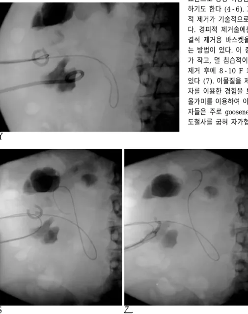 Fig. 3. A fragmented PCN catheter in a 52-year-old woman with renal  tubercu-losis (Patient 4,     Table 1)
