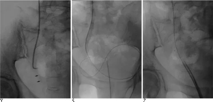 Fig. 5. Distal ureter stones with UVJ stricture in a 53-year-old woman ( Patient 3, Table 2).