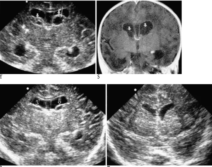 Fig. 2. Full term 2-week-old patient with delayed myelination. Paraventricular cysts with thick wall and septations.