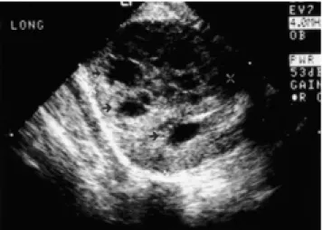 Fig. 2. A. A pre-enhanced CT of the pelvis shows a mass of 9×9×10 cm in dimension. And the mass has a well-defined and lobu- lobu-lated contour and has a cystic component.