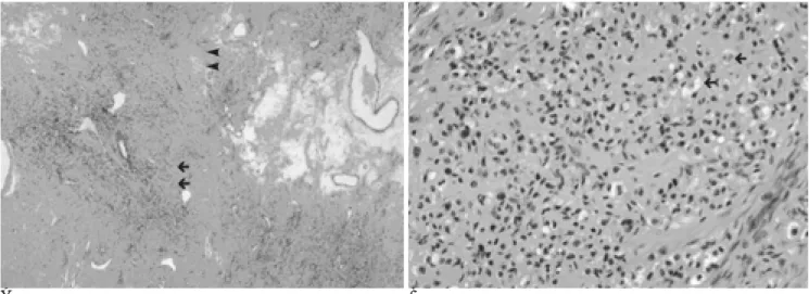 Fig. 4. A. Microscopically, sections show a pseudolobular pattern of cellular zones (arrows) separated by acelluar sclerotic or ede- ede-matous stroma (arrowheads) (H &amp; E stain, ×40).