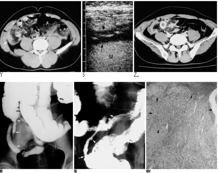 Fig. 1. A 27-year-old man with posttraumatic intestinal stenosis. 