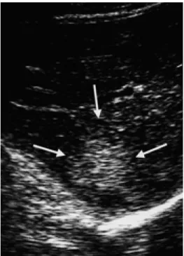 Fig. 1. Sonography shows a echogenic lesion with a subtle hy- hy-poechoic rim in the right lobe of the liver (arrows).