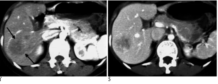 Fig. 2. A. The hepatic arterial phase shows an ill-defined low atten- atten-uated lesion compared with the surrounding liver parenchyma (arrows) on CT.