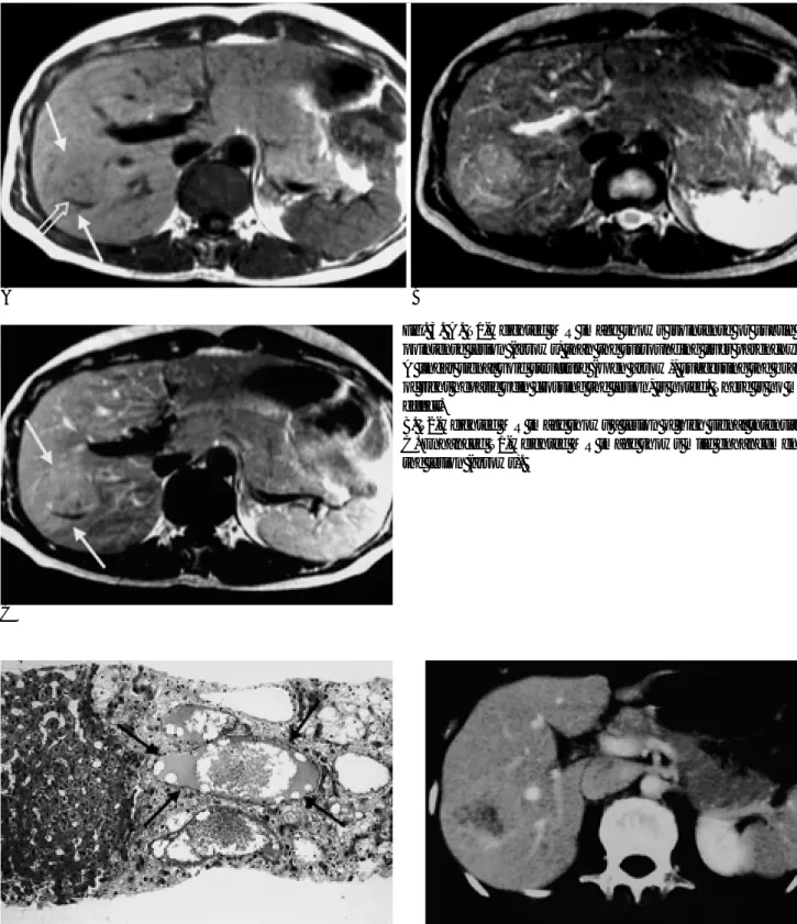 Fig. 3. A. T1-weighted MR image shows isointense or subtle hy- hy-pointense lesion (arrows) than the surrounding liver parenchyma.