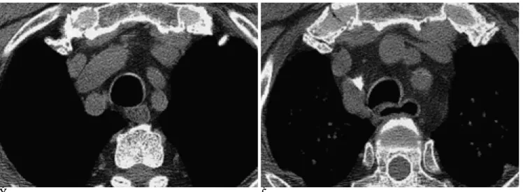 Fig. 2. Cross sectional shape of normal trachea in healthy person.