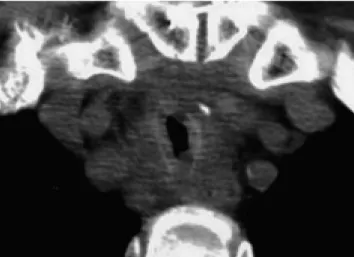 Fig. 11. A 72-year-old man with history of chronic obstructive pulmonary disease.