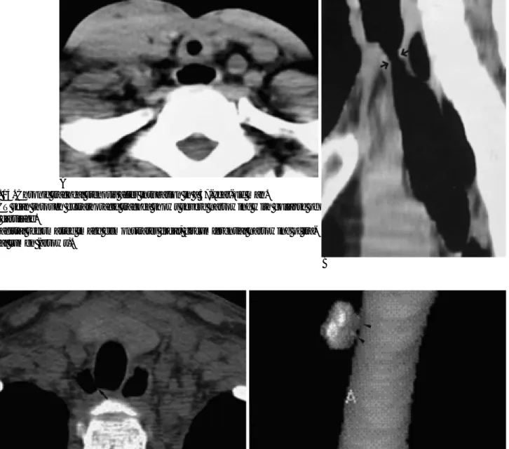 Fig. 15. Tracheal diverticulum in a 22-year-old man. He has suffered from prolonged, severe cough due to bronchial compression by thymic lymphoma.