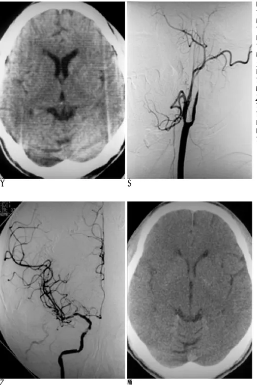 Fig. 1. A 60-year-old male with sudden left hemiparesis and dysarthria NIHSS score at admission is 17 .
