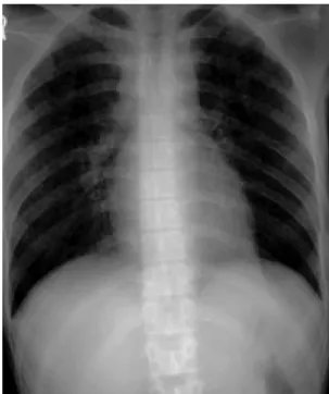 Fig. 2. A 23-year-old man with miliary tuberculosis who did not develop acute respiratory failure
